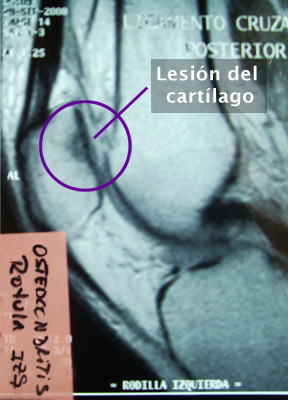 6. Osteocondritis de Rotula - Evidencia 1