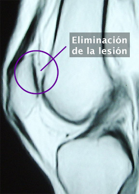 6. Osteocondritis de Rotula - Evidencia 2