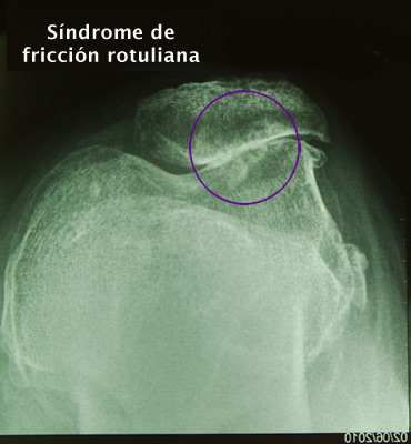 5. Lesion osteocondral, Edema óseo y Síndrome de fricción rotuliana - Evidencia 1
