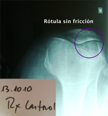 5. Lesion osteocondral, Edema óseo y Síndrome de fricción rotuliana - Evidencia 2