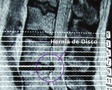 4. Hernia de Disco Lumbar (L4 – L5) - Evidencia 1