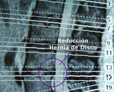 4. Hernia de Disco Lumbar (L4 – L5) - Evidencia 2