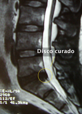 7. Hernia de Disco Lumbar (L5 – S1) EXTRUÍDA - Evidencia 1