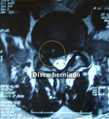 7. Hernia de Disco Lumbar (L5 – S1) EXTRUÍDA - Evidencia 3