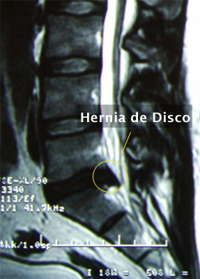 7. Hernia de Disco Lumbar (L5 – S1) EXTRUÍDA - Evidencia 2