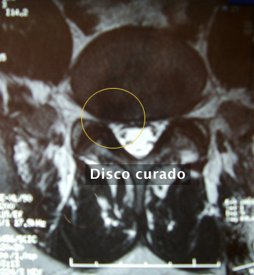 7. Hernia de Disco Lumbar (L5 – S1) EXTRUÍDA - Evidencia 4