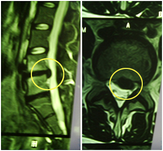 2. Hernia de disco Lumbar (L4 – L5) extruída - Evidencia 1