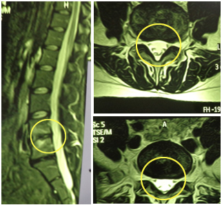 2. Hernia de disco Lumbar (L4 – L5) extruída - Evidencia 2