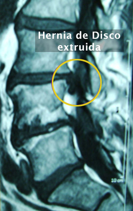 8. Hernia de Disco Lumbar y Radiculopatía - Evidencia 1