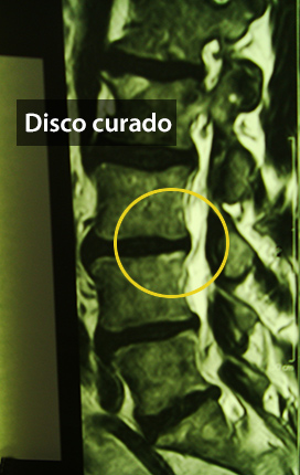 8. Hernia de Disco Lumbar y Radiculopatía - Evidencia 2