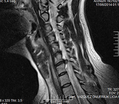 1. Voluminosa Hernia de Disco Cervical c6, c7 - Evidencia 1