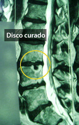 8. Hernia de Disco Lumbar y Radiculopatía - Evidencia 3
