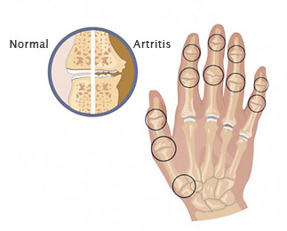 artritis2