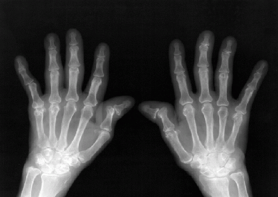 artritisradiografia