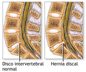 Hernia de Disco