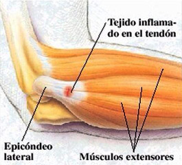 tendinitis2